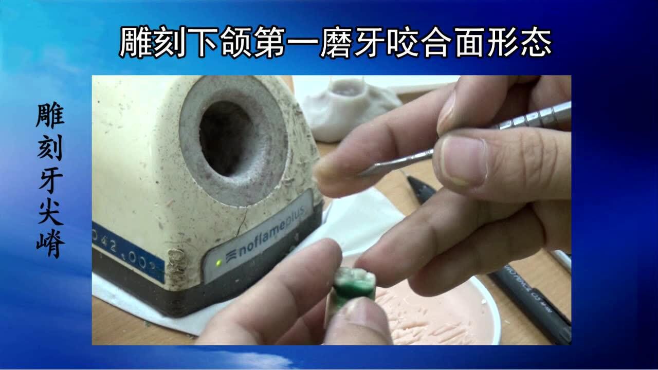 雕刻下颌第一磨牙咬合面形态