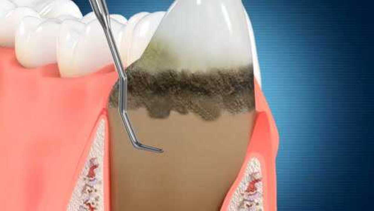 龈下刮治的主要过程_腾讯视频