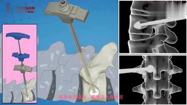 椎体成形手术动画 Nature期刊中文摘要的微博视频