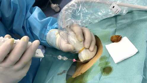 超声引导下徒手同轴肾穿刺活检术