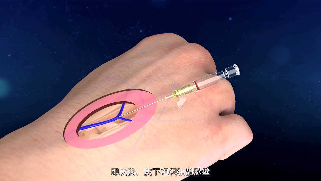 3d护理技能实训教学视频-静脉穿刺法(留置针穿刺)