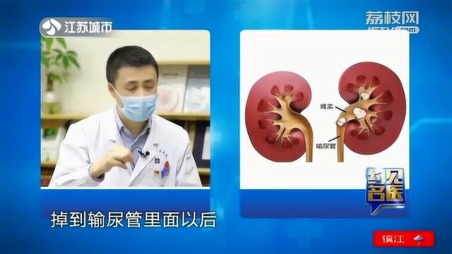 结石疼起来要人命?其实真正的肾结石 症状是这样的!