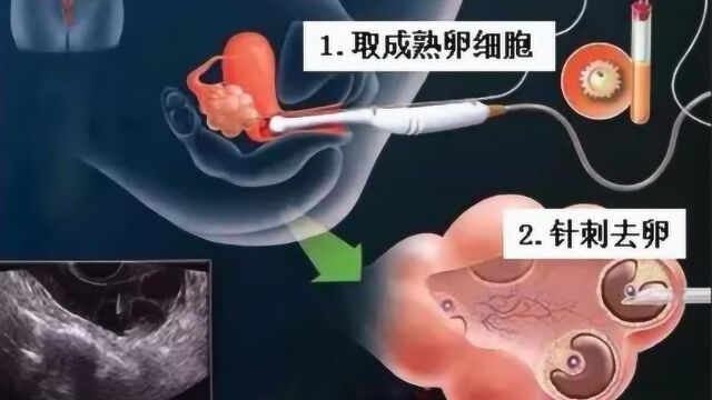 女大学生卖“卵子”收取3万费用,取卵手术曝光,看着都疼!