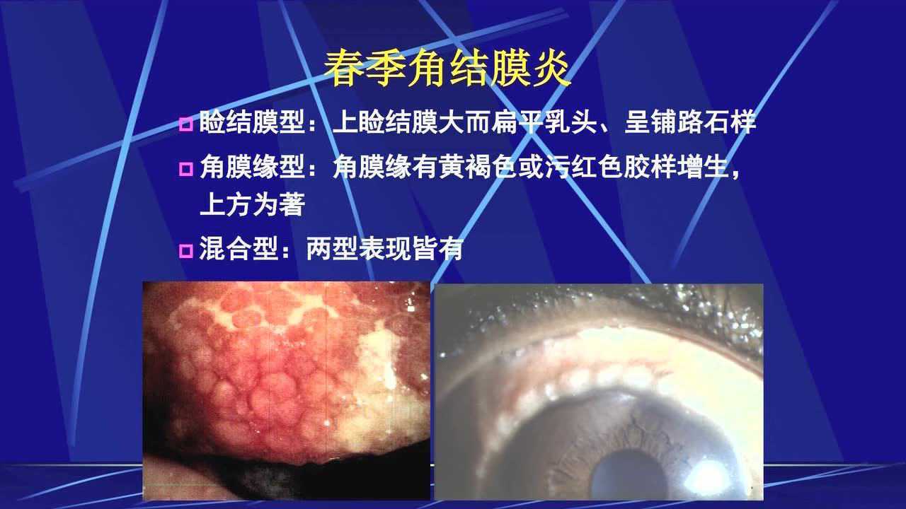 干眼诊断及治疗_腾讯视频