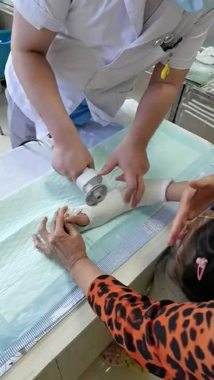 用电锯拆石膏,孩子打石膏没哭,拆石膏却吓哭了!