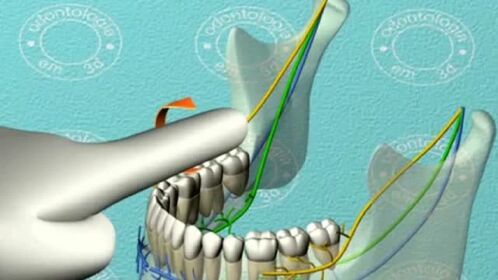 医生拔智齿时麻药打哪里的3d动画告诉你看完真后怕