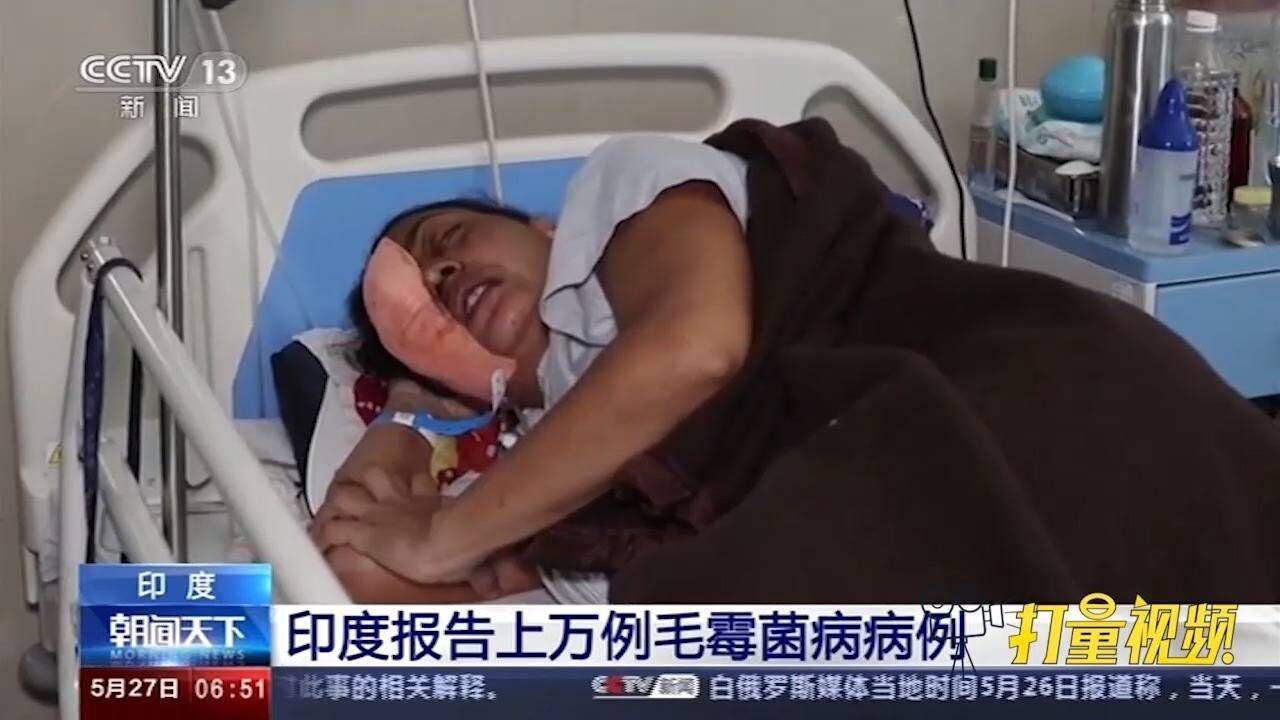 雪上加霜印度疫情遇严峻挑战上万人感染毛霉菌病