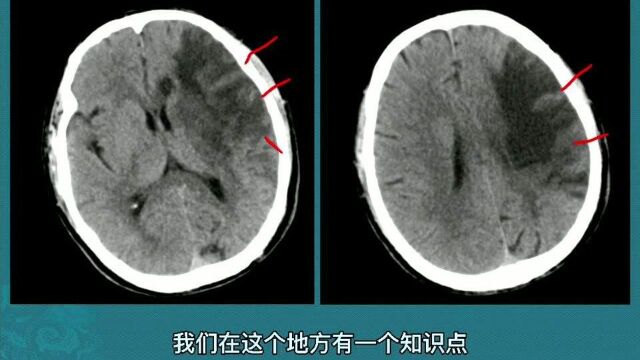 脑CT的这个血管变化,提示大面积脑梗,常需要介入手术