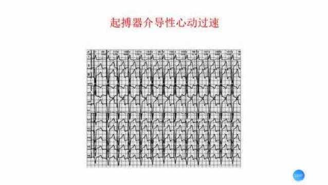 【心电视频】卢喜烈老师:心室起搏部位心电图表现