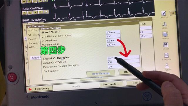 单Coil 除颤电极哪里关闭SVC?