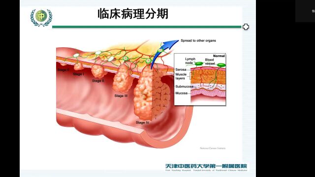 结直肠癌的治疗