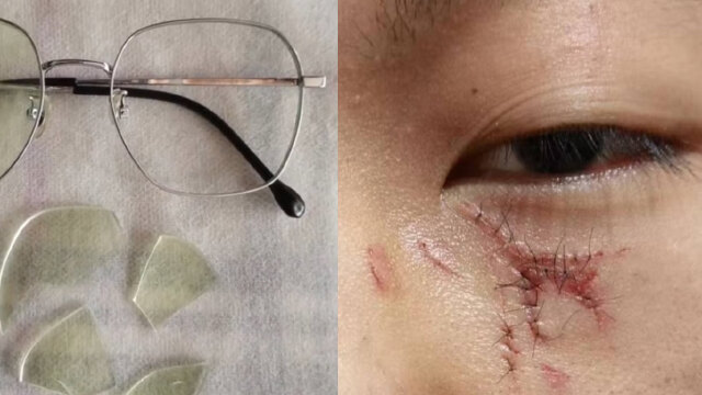 陕西15岁学生被老师拳击面部,眼下受伤缝16针,校长回应来了