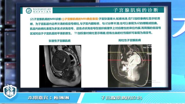 子宫腺肌病的诊治