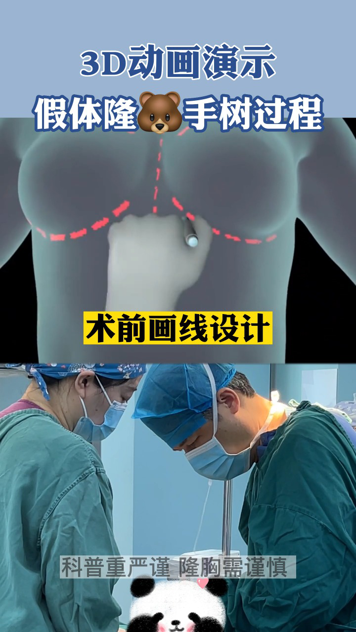3D动画演示：假体丰胸手术过程！_高清