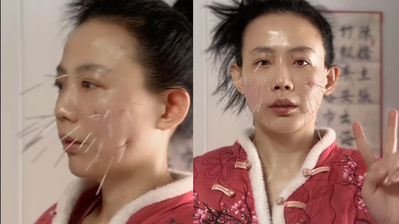 台湾武打女星针灸护肤,满脸扎针变刺猬不怕痛,吓坏网友:练武功绝技?