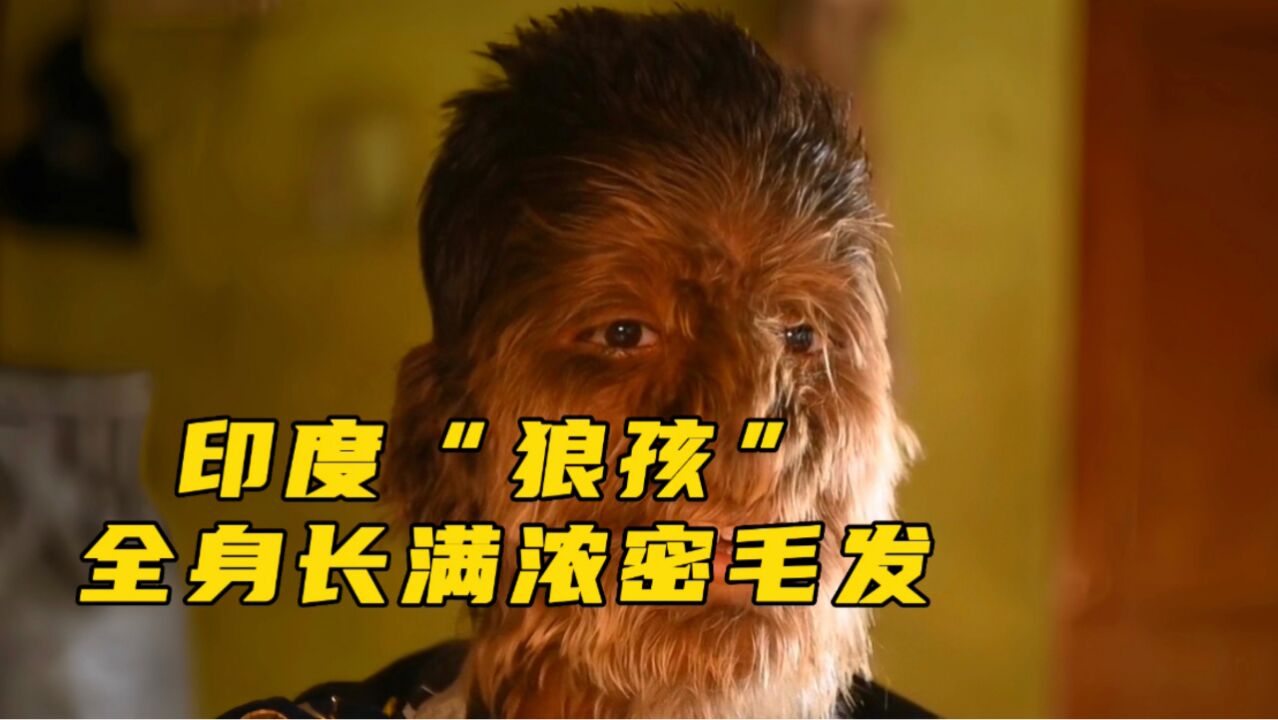 印度惊现“狼孩”，全身长着茂密毛发，全世界不超过20人！_高清1080P在线观看平台_腾讯视频