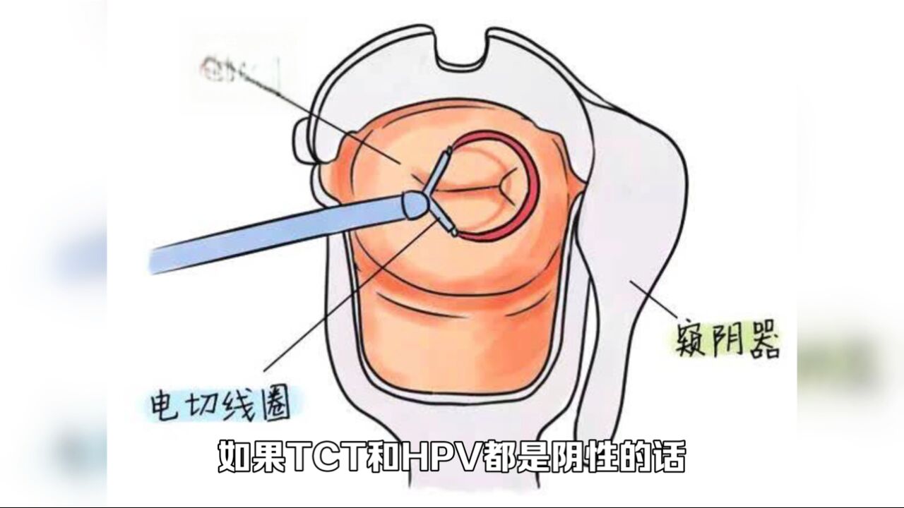 宫颈囊肿需要治疗吗?