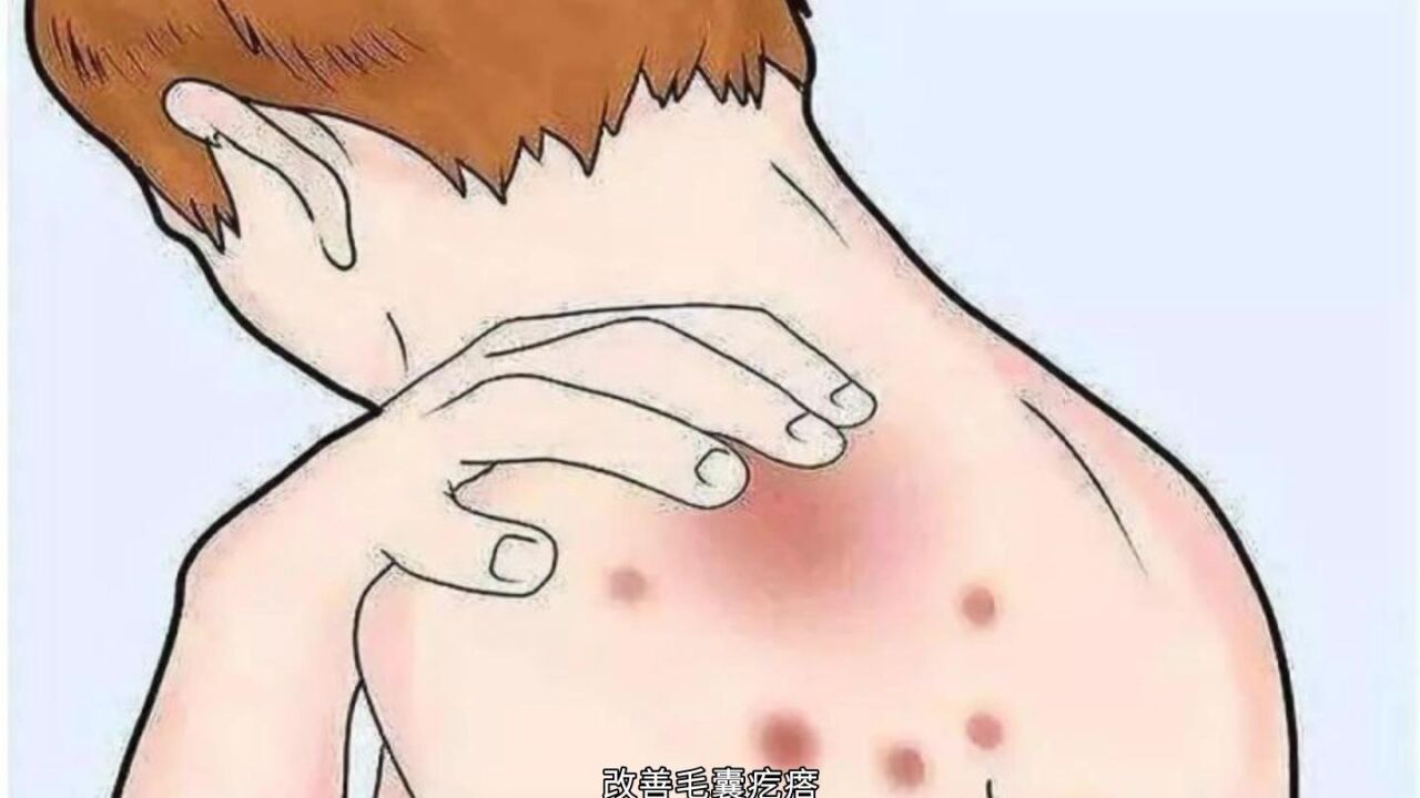 毛囊炎应该注意这些,小心感染
