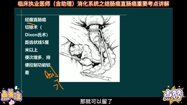 临床执业医师(含助理)消化系统之结肠癌直肠癌重要考点讲解