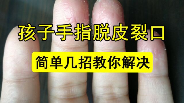 孩子手指脱皮裂口怎么办?简单几招教你解决孩子手脱皮的问题