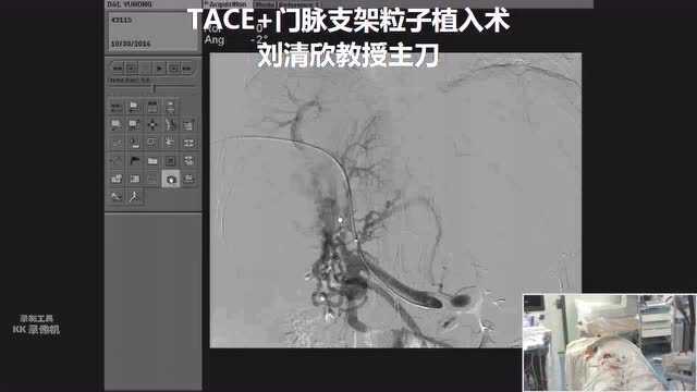 TIPS手术直播_腾讯视频