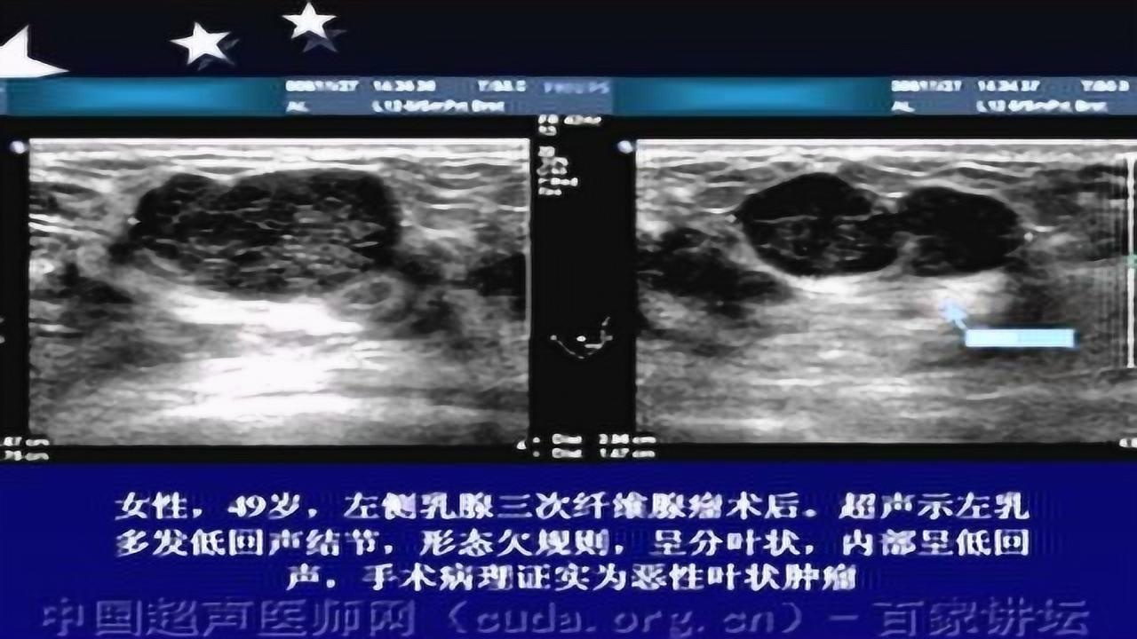 管状乳房の原因