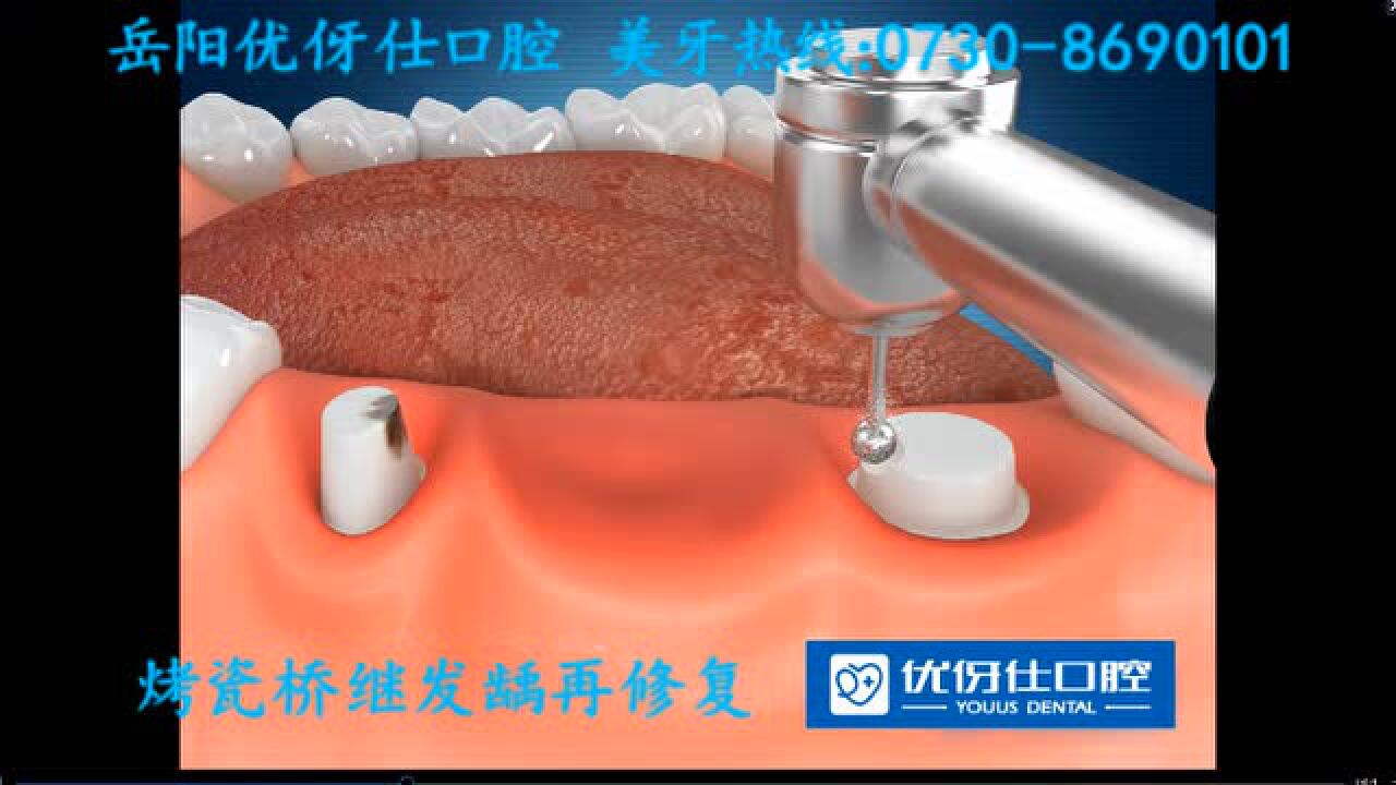 口腔固定修复-桥修复.动画演示_高清1080P在线观看平台_腾讯视频