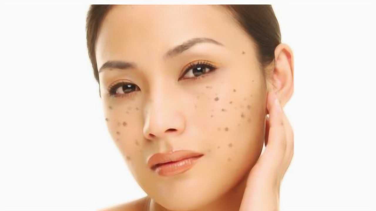 不用花上美容院,一招教你轻松祛除雀斑!