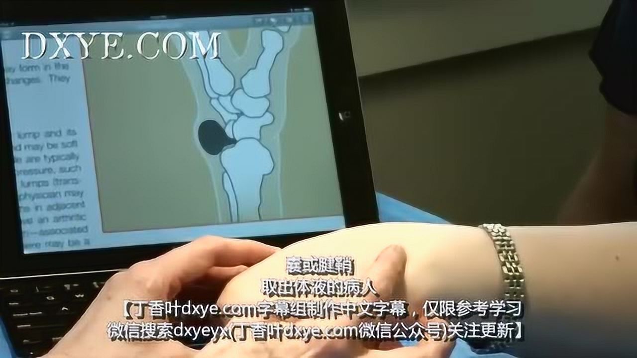 医学视频 腱鞘囊肿腾讯视频