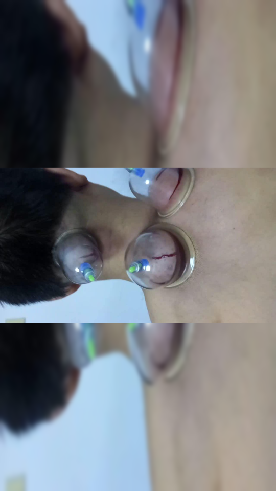 康健刺络排瘀疗法 拔罐放血调理头晕 头疼痛 失眠 颈椎病 肩周炎