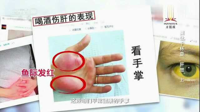 肝掌是怎么回事?专家解释其中原因 原来这么严重