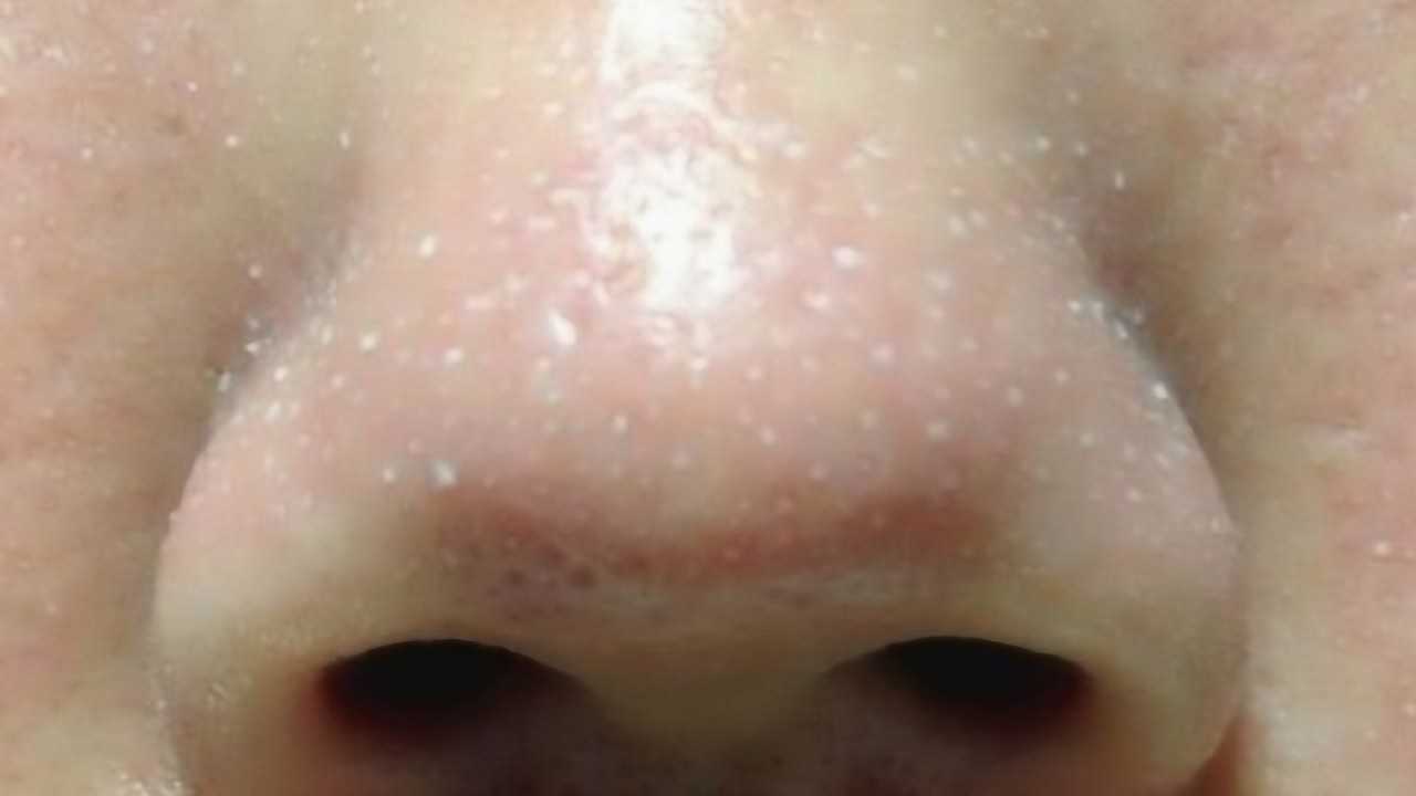 鼻子上令人讨厌的白头,真的是螨虫分泌物吗?看完你就明白了
