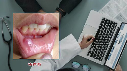 粘液腺囊肿,不开刀的新方法