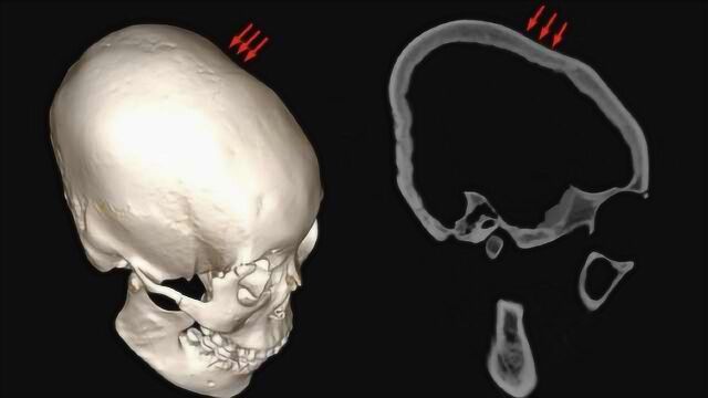 吉林大学考古团队发现人类颅骨人工变形迄今最早实物证据