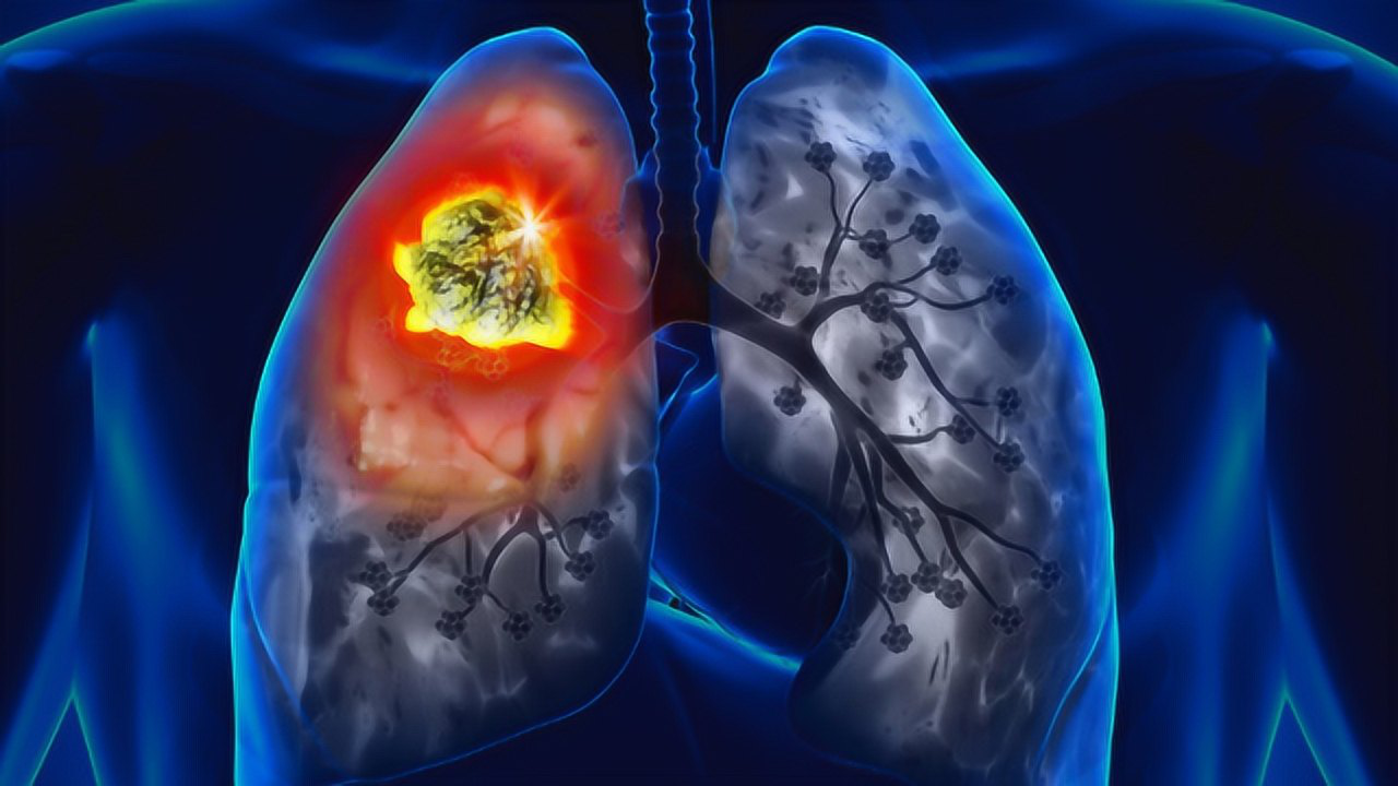 曾手术切除一半肺,出院后喝酒抽烟都不误,结果又被查出肺癌