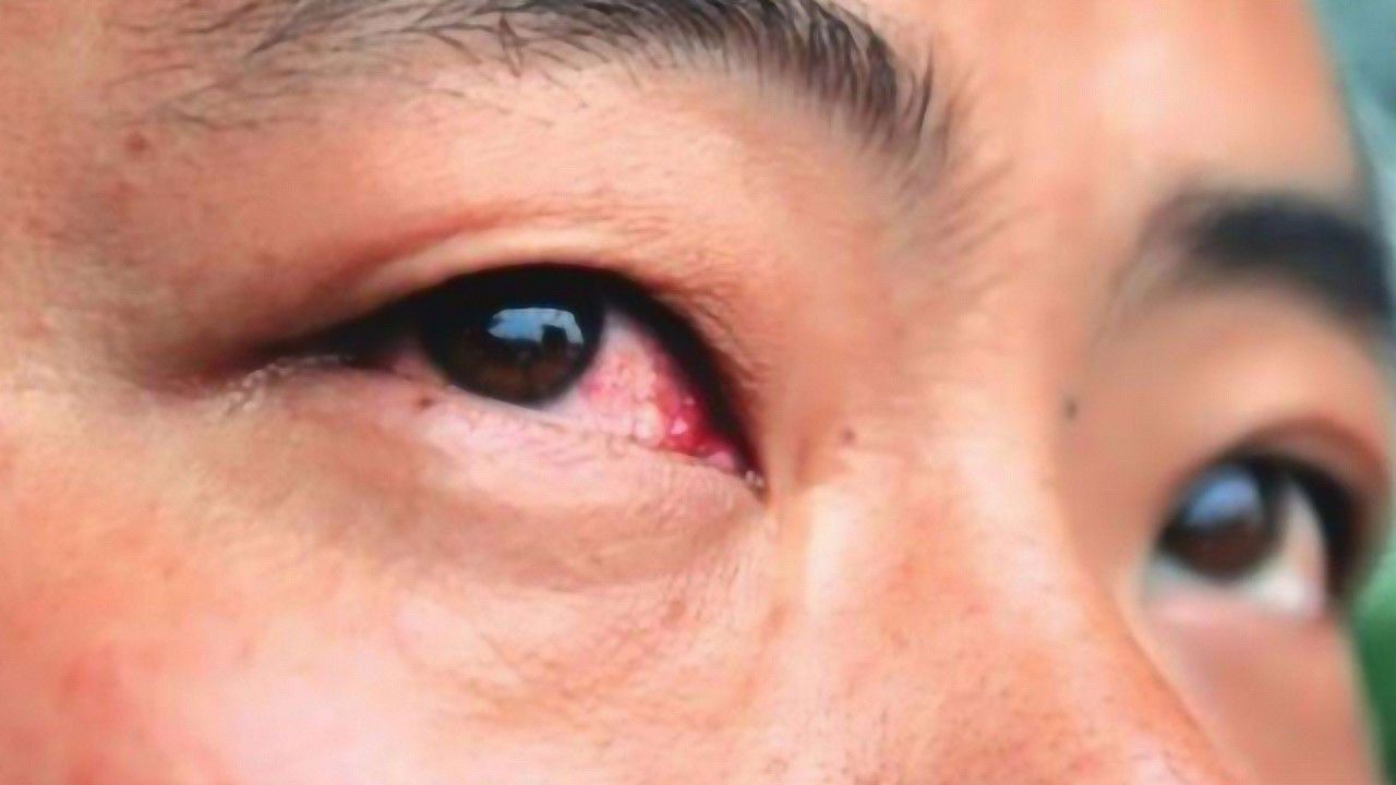 眼睛有红血丝不只是疲劳,可能是5种病作祟,忽视容易变瞎!