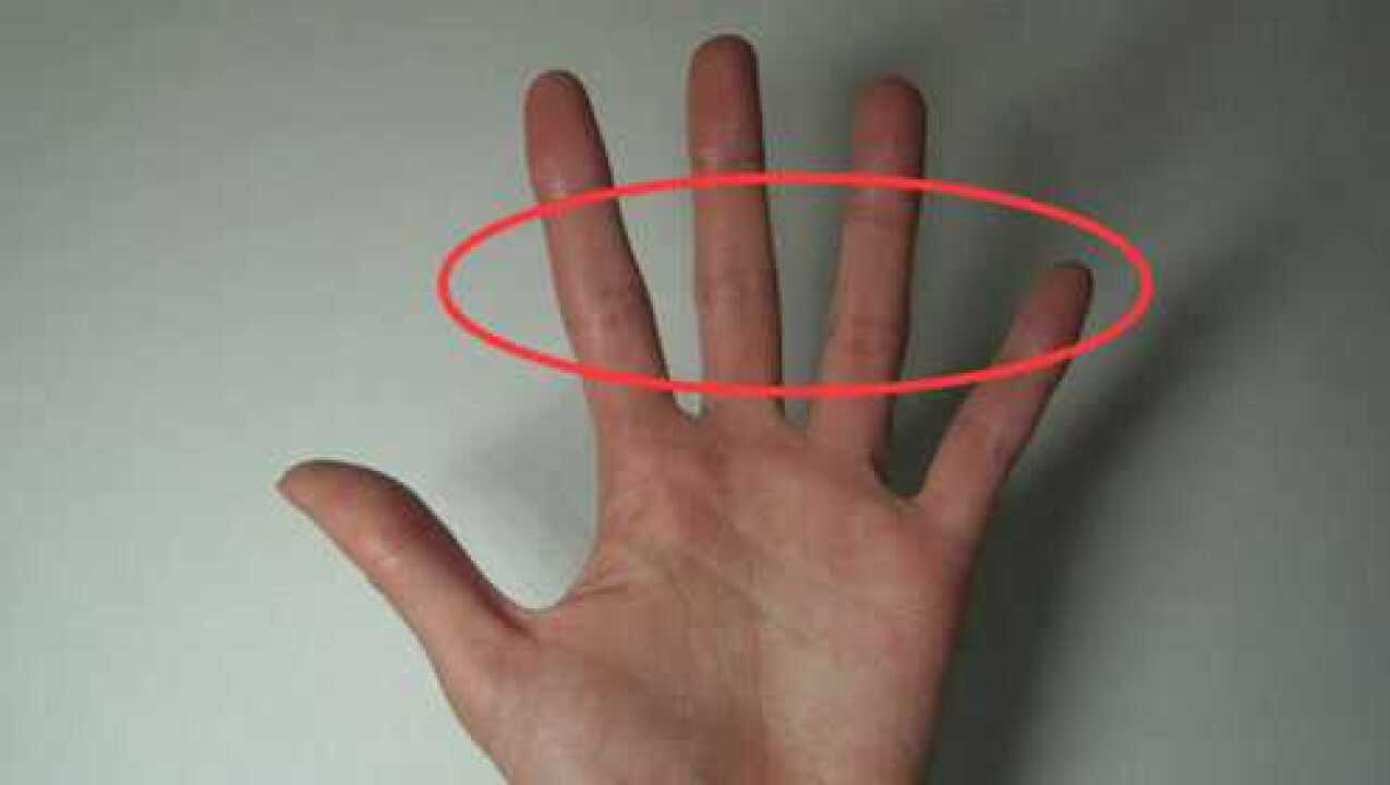 肺癌早期症状不明显一旦手上出现这东西说明肺部开始癌变了