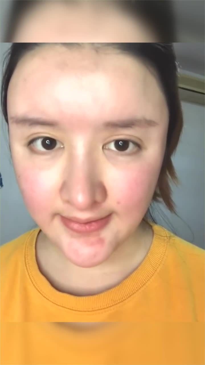 这就是整容的后遗症小姐姐全脸发红整容二十次还不知悔改