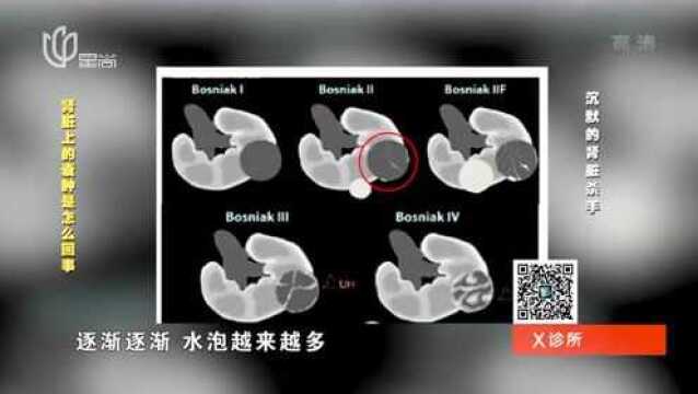 肾脏囊肿到什么程度才会病变?专家用图片解释,一定要知道