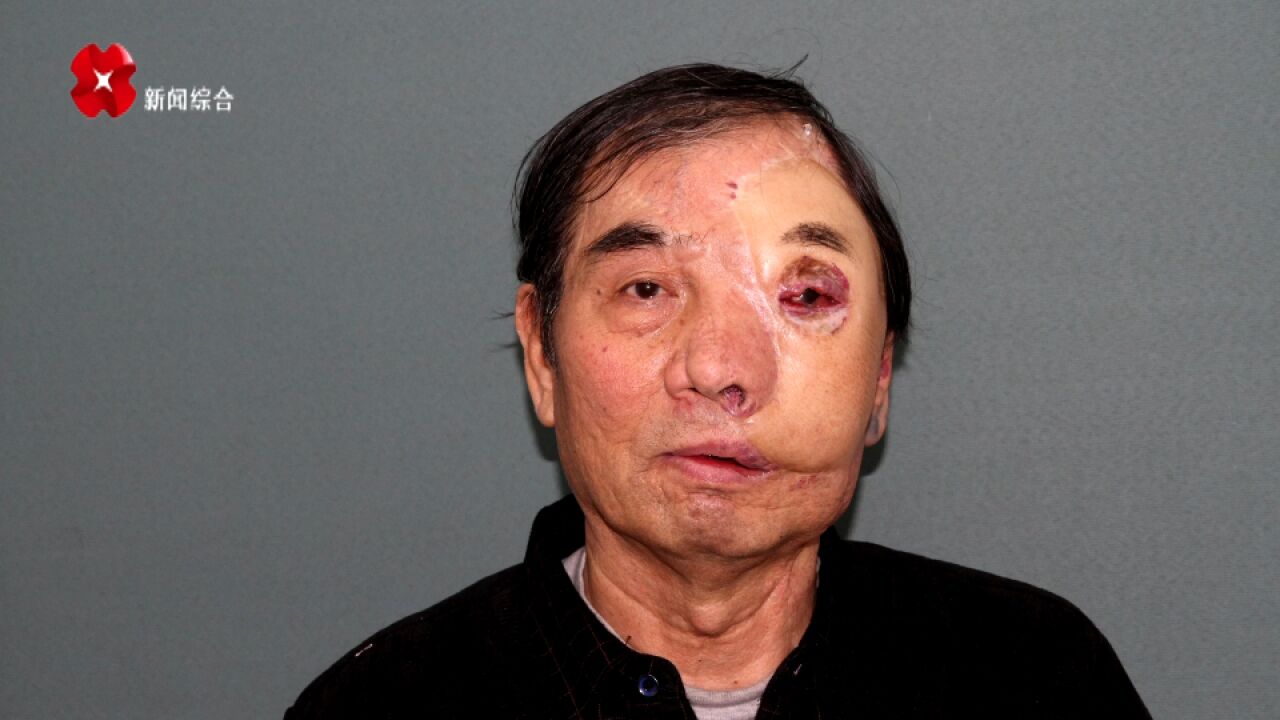 空军军医大学口腔医院成功完成一例  颌面部巨大脉管畸形修复重建病例