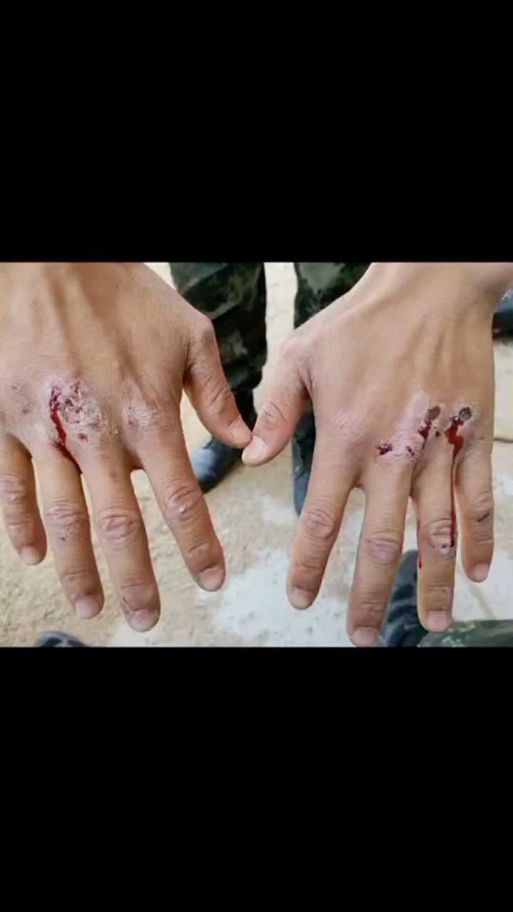 手上伤痕累累