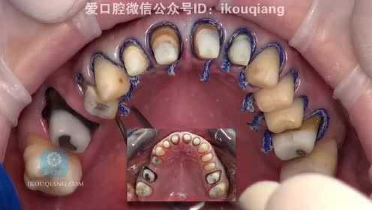 牙体制备、排龈_高清1080P在线观看平台_腾讯视频