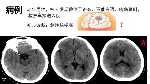 临床医技学影像诊断(精品视频课) 之 缺血性脑梗塞CTMR诊断