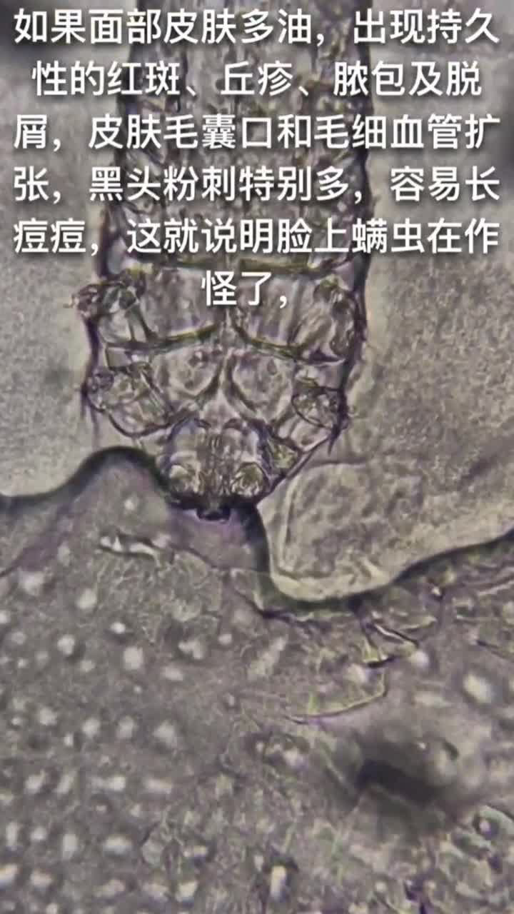 显微镜下的皮肤 黑头图片