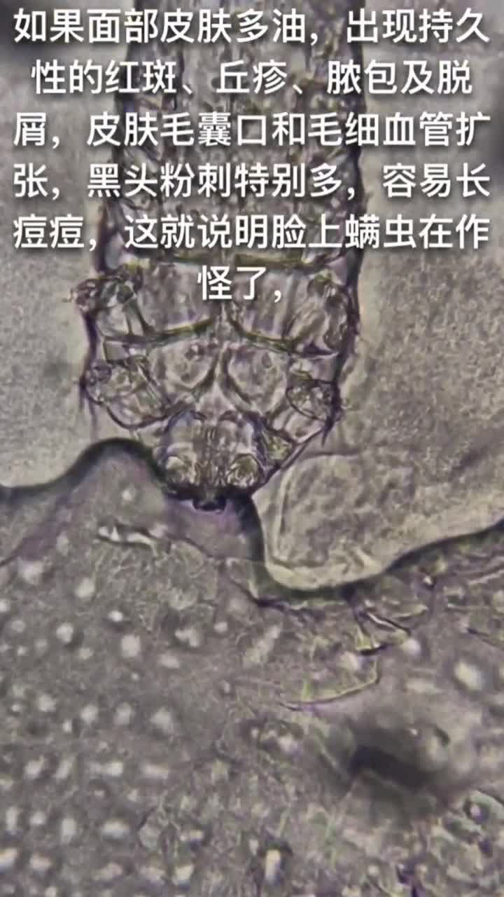 黑头粉刺,在显微镜下放大400倍发现螨虫在爬动,太恶心了