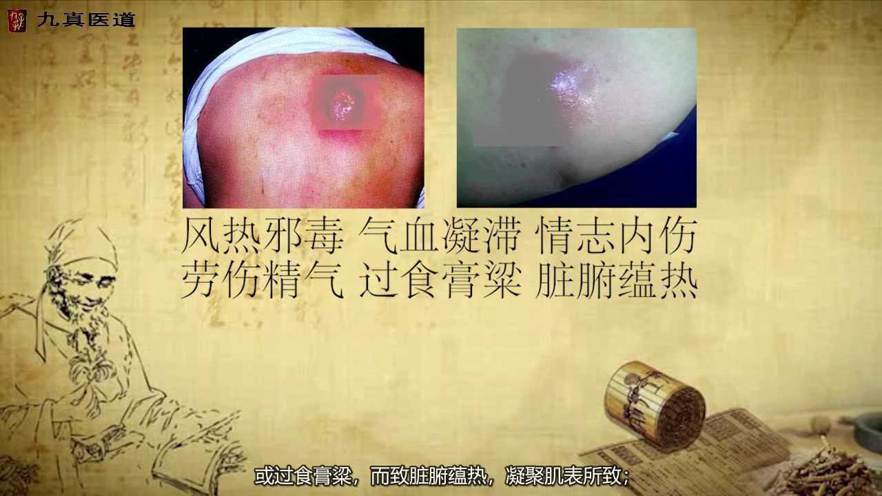 痈疽是泛指外科一切疮疡疾病_高清1080P在线观看平台_腾讯视频