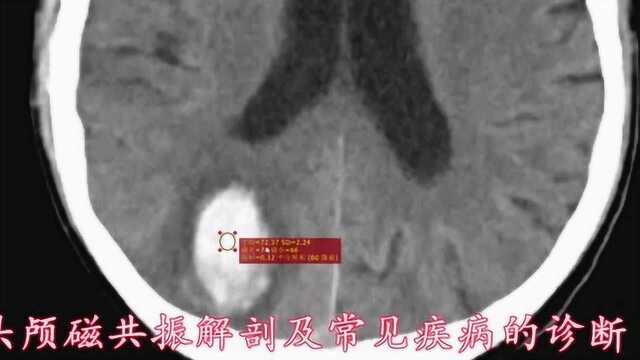 头部CT解剖及常见疾病怎么看?放射科医生讲解——全是干货