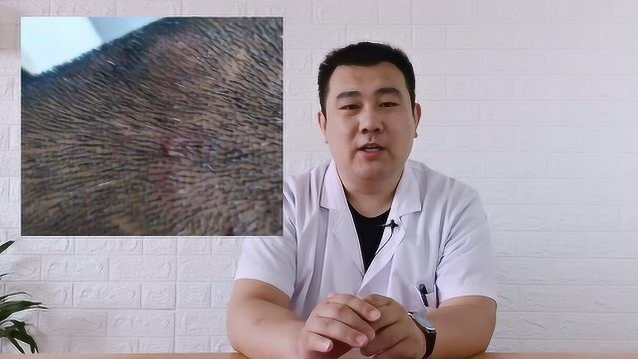 头皮上经常长一些小疙瘩是怎么回事？_高清