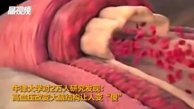 高血压改变大脑结构让人变“傻” 牛津大学团队发表研究报告