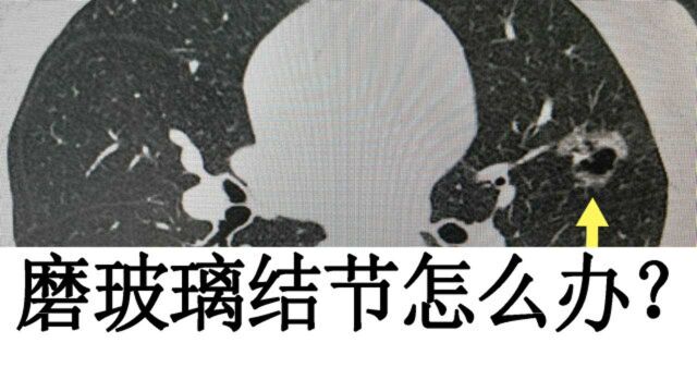 磨玻璃结节观察后会有哪三种结果?怎么处理?